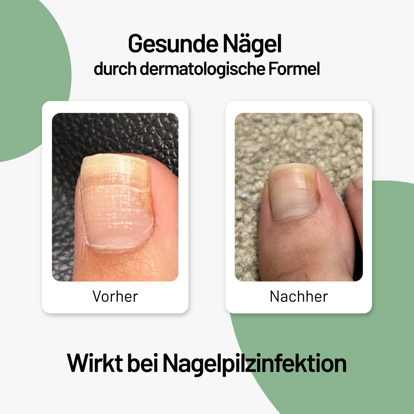 Nail Care Pen gegen Nagelpilz